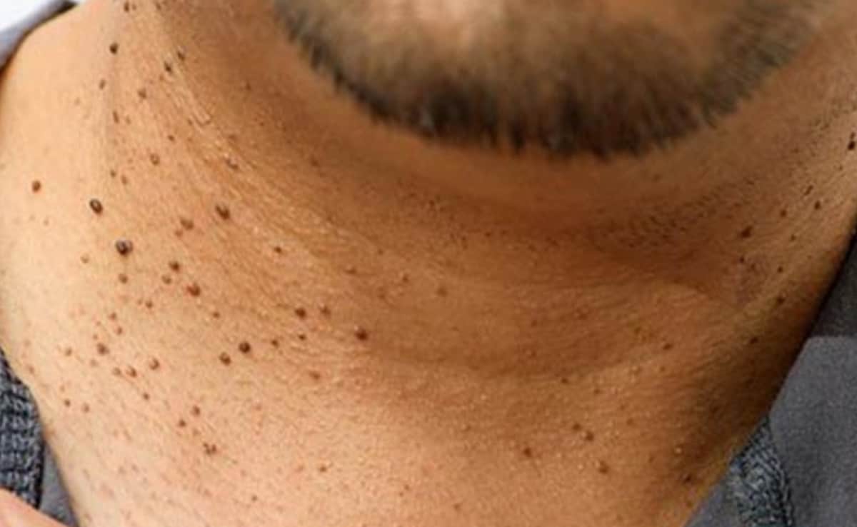 Are Skin Tags Normal? They Could Be A Sign Of Insulin Resistance, Warns Doctor