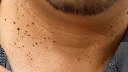 Are Skin Tags Normal? They Could Be A Sign Of Insulin Resistance, Warns Doctor