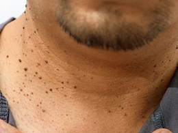 Are Skin Tags Normal? They Could Be A Sign Of Insulin Resistance, Warns Doctor
