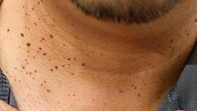 Research suggests that skin tags can sometimes be associated with insulin resistance