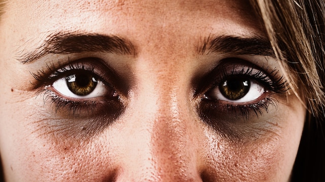 If dark circles stick around, it might point to an iron deficiency