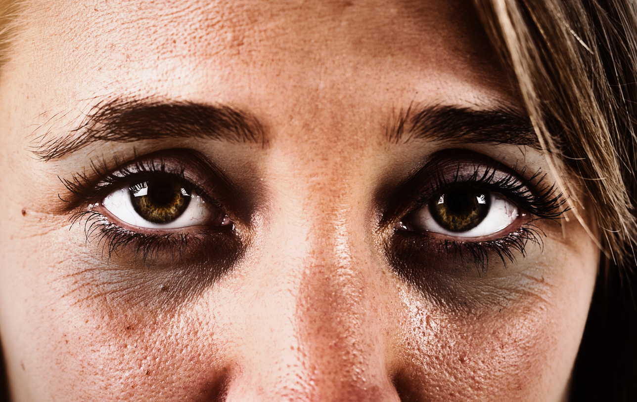 If dark circles stick around, it might point to an iron deficiency