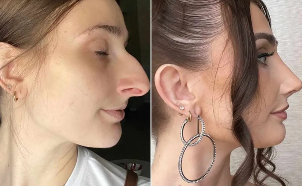 Девин Айкен 30 годишна от Филаделфия имаше ринопластика струваща Rs 9 1