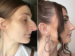 US Influencer Leaves "Miserable" Marriage After Rs 9 Lakh Nose Job Boosts Her Confidence US Influencer Leaves "Miserable" Marriage After Rs 9 Lakh Nose Job Boosts Her Confidence