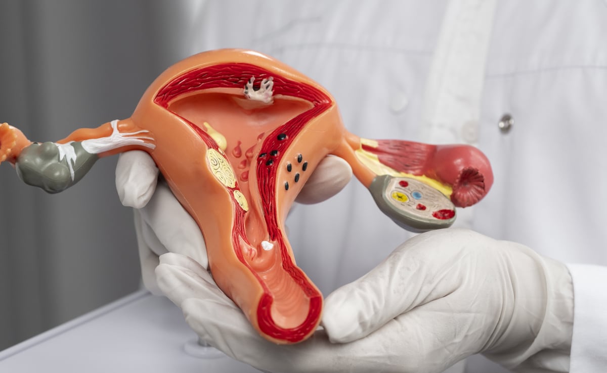 Ovarian cysts are common. (Image Courtesy: Freepik) Ovarian cysts are common. (Image Courtesy: Freepik)