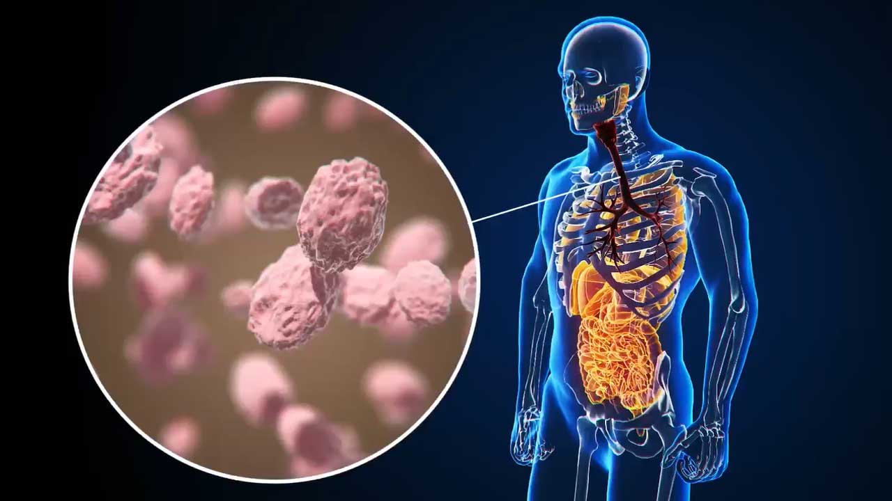 When Medicine Fails, Infection Prevails