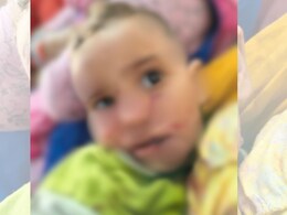 राजस्थान में कुत्तों का आतंक, ढाई साल की बच्ची को बुरी तरह नोचा, हर महीने 1 हजार से ज्यादा को बना रहे शिकार