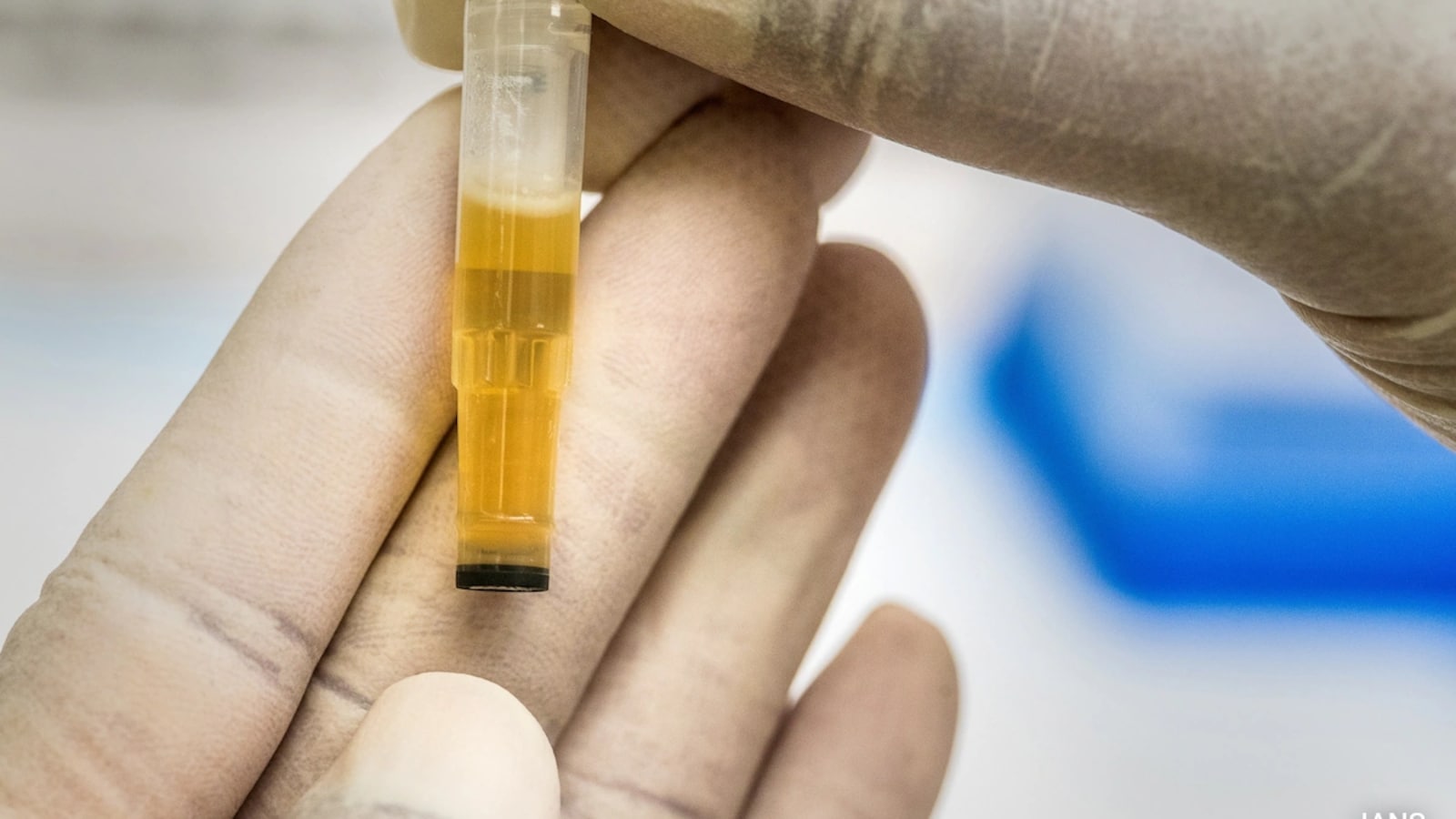 New At-Home Urine Test Detects 92% of Bladder Cancers