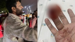 In Bengaluru, Man Bites Another Man's Finger For Splashing Rainwater