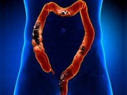 Gene Editing : क्या जीन एडिटिंग थेरेपी कोलोरेक्टल कैंसर के इलाज में साबित होगी कारगर? जानें क्या कहती है रिपोर्ट