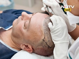 Hair Transplant: हँडसम दिसण्याच्या नादात तरुणाचा जीव गेला!  हेअर ट्रान्सप्लांट करण्याआधी 'हे' वाचा Hair Transplant: हँडसम दिसण्याच्या नादात तरुणाचा जीव गेला!  हेअर ट्रान्सप्लांट करण्याआधी 'हे' वाचा