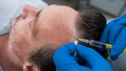 Can A Faulty Hair Transplant Kill You? We Asked Experts