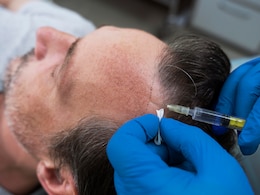 Can A Faulty Hair Transplant Kill You? We Asked Experts