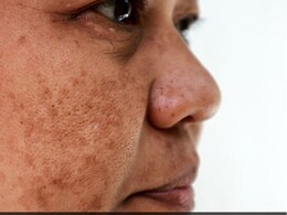 चेहरे से हाइपरपिग्मेंटेशन और झाइयों का सफाया कर सकते हैं ये 5 नेचुरल तरीके, रिसर्च भी कहती है असरदार चेहरे से हाइपरपिग्मेंटेशन और झाइयों का सफाया कर सकते हैं ये 5 नेचुरल तरीके, रिसर्च भी कहती है असरदार