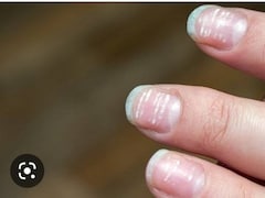 White Spot On Nails: नाखूनों में सफेद धब्बे किस चीज कमी की वजह से होते हैं?