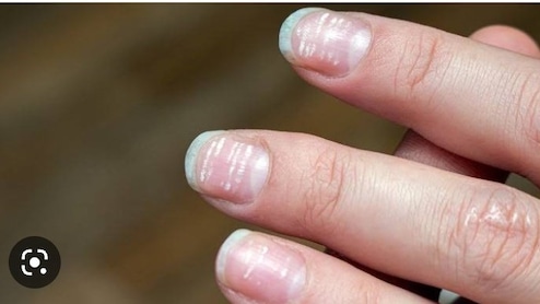 White Spot On Nails: नाखूनों में सफेद धब्बे किस चीज कमी की वजह से होते हैं?