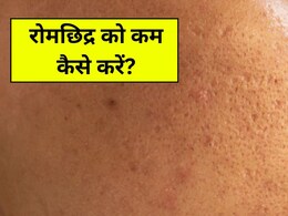 चेहरे पर ज्यादा दिखने लगे हैं रोमछिद्र? स्किन के डॉक्टर से जानें Open Pores को कम करने के लिए क्या करें चेहरे पर ज्यादा दिखने लगे हैं रोमछिद्र? स्किन के डॉक्टर से जानें Open Pores को कम करने के लिए क्या करें
