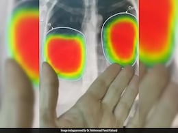 Dubai Doctor Fears Losing His Job As AI Accurately Analyses X-Ray: "Going To Apply To McDonald's" Dubai Doctor Fears Losing His Job As AI Accurately Analyses X-Ray: "Going To Apply To McDonald's"