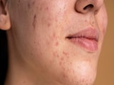 Nutritionist Reveals How 'Acne Mapping' Can Transform Your Skin Nutritionist Reveals How 'Acne Mapping' Can Transform Your Skin