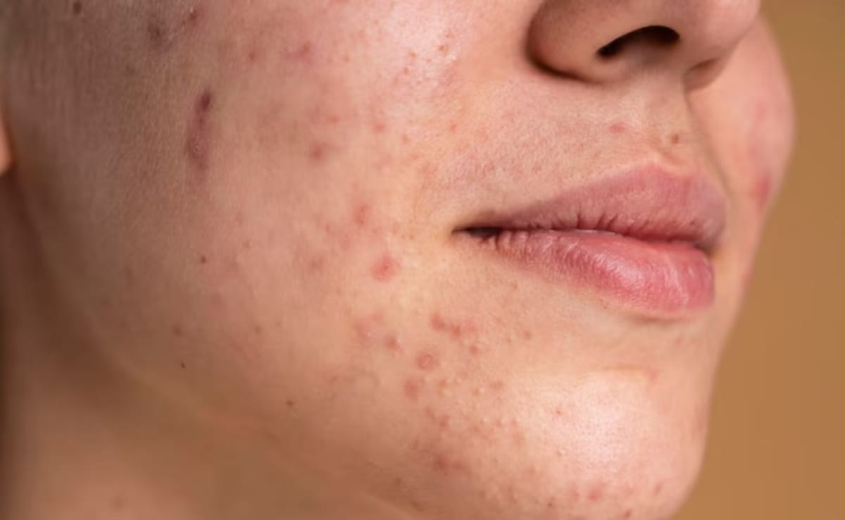 Can Botox Reduce Acne Pigmentation? New Study Offers Hope
