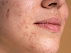 Can Botox Reduce Acne Pigmentation? New Study Offers Hope