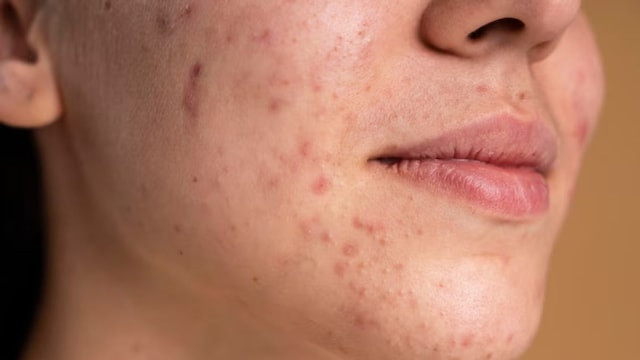 Stress, Sleep And Sugar: Dermatologist Shares The Lifestyle Triggers Behind Sudden Acne In 30s And 40s