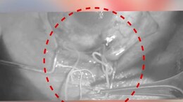 Eye Operation : दुर्मीळ प्रकरण! एक मच्छर अन् डोळ्यात 10 सेमी किडा झाला तयार; नेत्रतज्ज्ञही चक्रावले