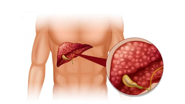 Nutritionist Reveals Common Warning Signs Of A Fatty Liver Condition