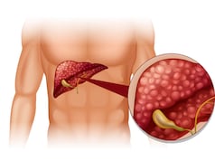 6 महीने में ग्रेड-2 फैटी लिवर से लगभग नॉर्मल! बिना दवा, बिना सप्लीमेंट, डॉक्टर ने बताए 2 लाइफस्टाइल बदलाव