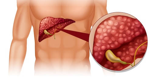 How To Reverse Fatty Liver Naturally: Follow These Diet And Lifestyle Tips