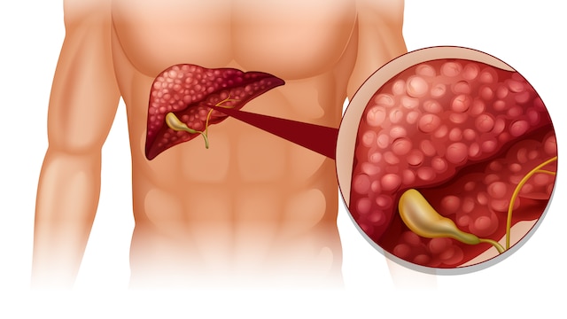 Alcohol can have a detrimental effect on the liver
