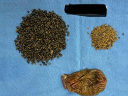 गोलब्लैडर या किडनी में ही नहीं, मुंह से लेकर प्रोस्टेट तक शरीर के इन 10 अंगों में बन सकती है पथरी गोलब्लैडर या किडनी में ही नहीं, मुंह से लेकर प्रोस्टेट तक शरीर के इन 10 अंगों में बन सकती है पथरी