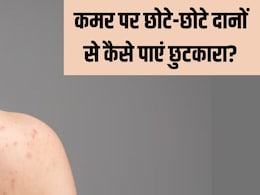 Back Acne: कमर पर भद्दे दिखते हैं छोटे-छोटे दाने? स्किन की डॉक्टर से जान लें कैसे पाएं बैक एक्ने से छुटकारा Back Acne: कमर पर भद्दे दिखते हैं छोटे-छोटे दाने? स्किन की डॉक्टर से जान लें कैसे पाएं बैक एक्ने से छुटकारा
