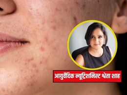 सेलिब्रिटी न्यूट्रिशनिस्ट ने बताया चेहरे पर दाग-धब्बों और एक्ने से कैसे पाएं छुटकारा, महंगे ट्रीटमेंट से पहले कर लें ये काम सेलिब्रिटी न्यूट्रिशनिस्ट ने बताया चेहरे पर दाग-धब्बों और एक्ने से कैसे पाएं छुटकारा, महंगे ट्रीटमेंट से पहले कर लें ये काम