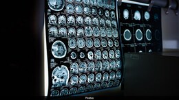 What Is AV Malformation? All About It