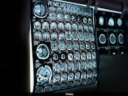 What Is AV Malformation? All About It