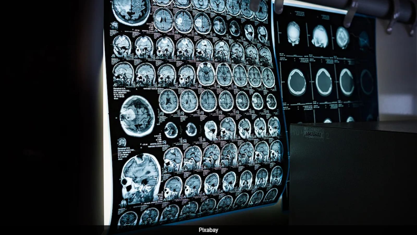 Indian Hospitals Perform Complex Brain Tumour Surgeries with Positive Outcomes