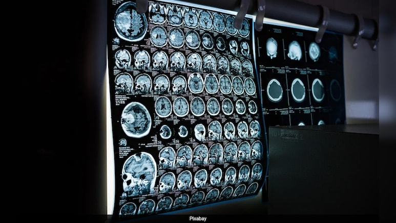 Doctors Remove Tumour From Woman's Brain As She Watches Pawan Kalyan Film