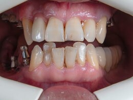 क्यों घिस जाते हैं दांत, क्या घिसे हुए दांत हो सकते हैं ठीक, क्या हैं इसके लिए घरेलू नुस्खे