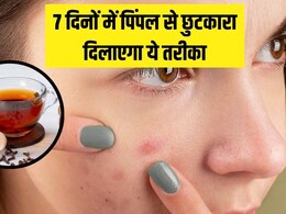 आयुर्वेदिक एक्सपर्ट ने बताया 7 दिनों में पिंपल्स से छुटकारा पाने का तरीका, पित्त को शांत कर स्किन को अंदर से साफ कर देगा ये नुस्खा आयुर्वेदिक एक्सपर्ट ने बताया 7 दिनों में पिंपल्स से छुटकारा पाने का तरीका, पित्त को शांत कर स्किन को अंदर से साफ कर देगा ये नुस्खा