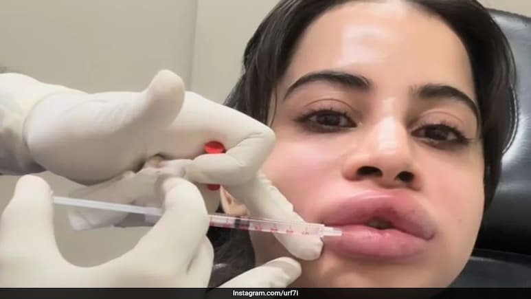 Uorfi Javed Gets Her Fillers Dissolved, Says, "I Will Get Them Again But Naturally" Uorfi Javed Gets Her Fillers Dissolved, Says, "I Will Get Them Again But Naturally"