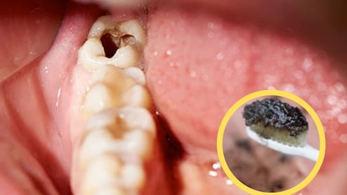 पीले दांतों को मोतियों की तरह चमकदार बना देगा घर पर बना ये टूथपेस्ट, Teeth Cavity में भी है असरदार