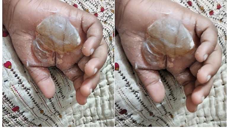 ट्यूशन टीचर की शर्मनाक हरकत! राइटिंग पसंद नहीं आई तो बच्चे का हाथ जलती मोमबत्ती से जलाया ट्यूशन टीचर की शर्मनाक हरकत! राइटिंग पसंद नहीं आई तो बच्चे का हाथ जलती मोमबत्ती से जलाया