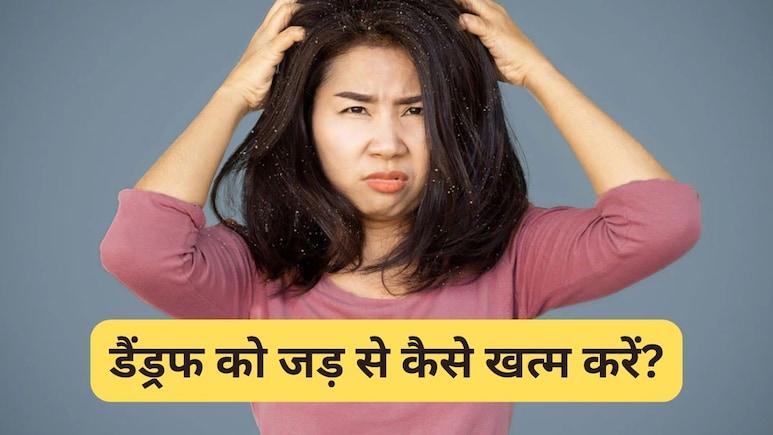 डैंड्रफ को जड़ से कैसे खत्म करें? एक्सपर्ट ने बताया दही में मिलाकर लगाएं यह एक मसाला, स्कैल्प की हो जाएगी सफाई