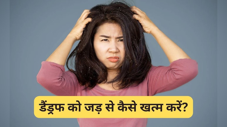 डैंड्रफ से भर गया है सिर और झड़ती है रूसी तो Dr. Hansaji Yogendra के बताए ये 3 नुस्खे आएंगे काम, साफ हो जाएंगे बाल