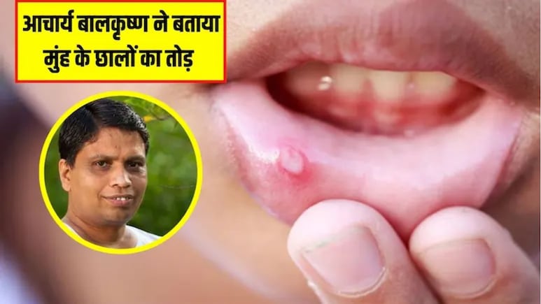 Acharya Balkrishna ने बताया मुंह के छाले ठीक करने का असरदार नुस्खा, इस एक पत्ते से नेचुरली दूर हो जाएगी दिक्कत