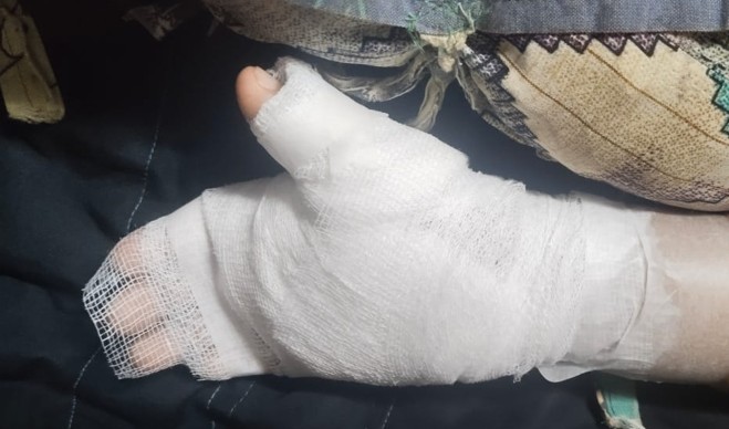 Mumbai Teacher Burns 8-Year-Old's Hand With Candle Over Bad Handwriting