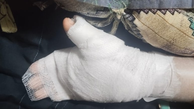 Mumbai Teacher Burns 8-Year-Old's Hand With Candle Over Bad Handwriting