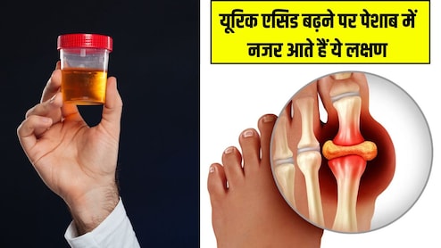 Uric Acid बढ़ने पर पेशाब में नजर आते हैं ये लक्षण, डॉ. ने बताया ये खाने से बाहर आ जाएंगे सारे टॉक्सिन