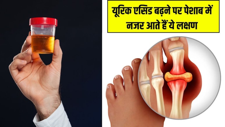 Uric Acid बढ़ने पर पेशाब में नजर आते हैं ये लक्षण, डॉ. ने बताया ये खाने से बाहर आ जाएंगे सारे टॉक्सिन